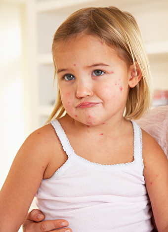 Çocuklarda besin alerjisi nasıl tedavi edilir?