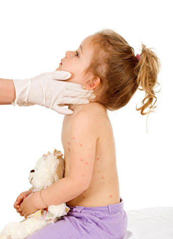 Çocuklarda besin alerjisi nasıl tedavi edilir?
